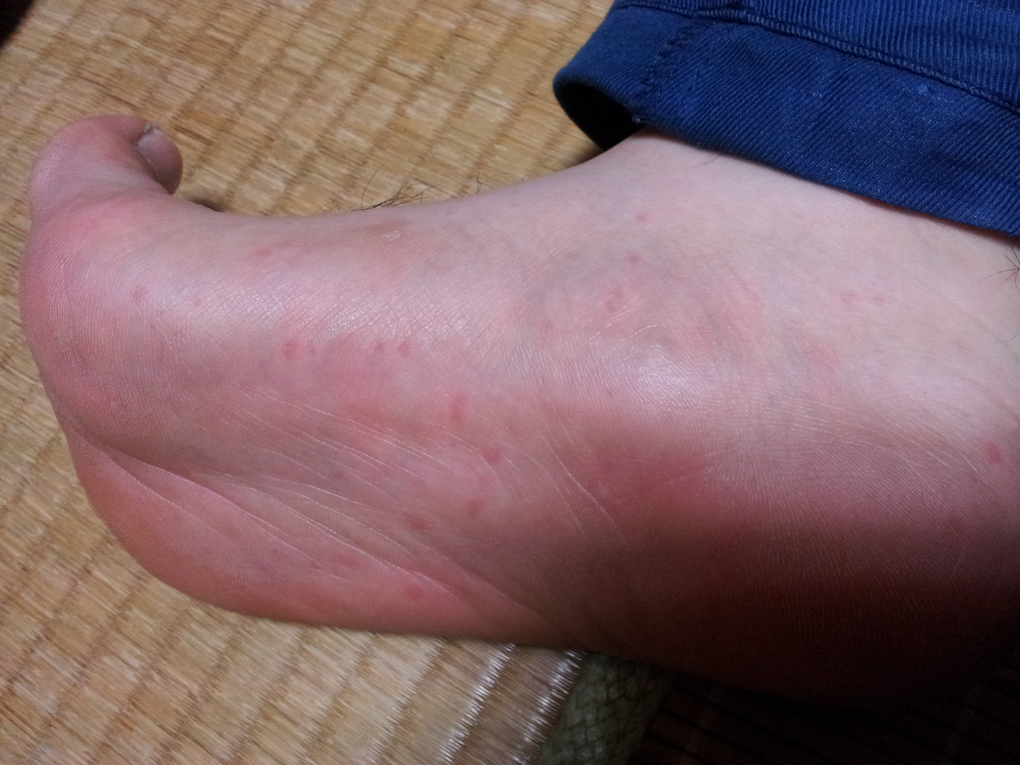 足の裏に出ている赤い蕁麻疹