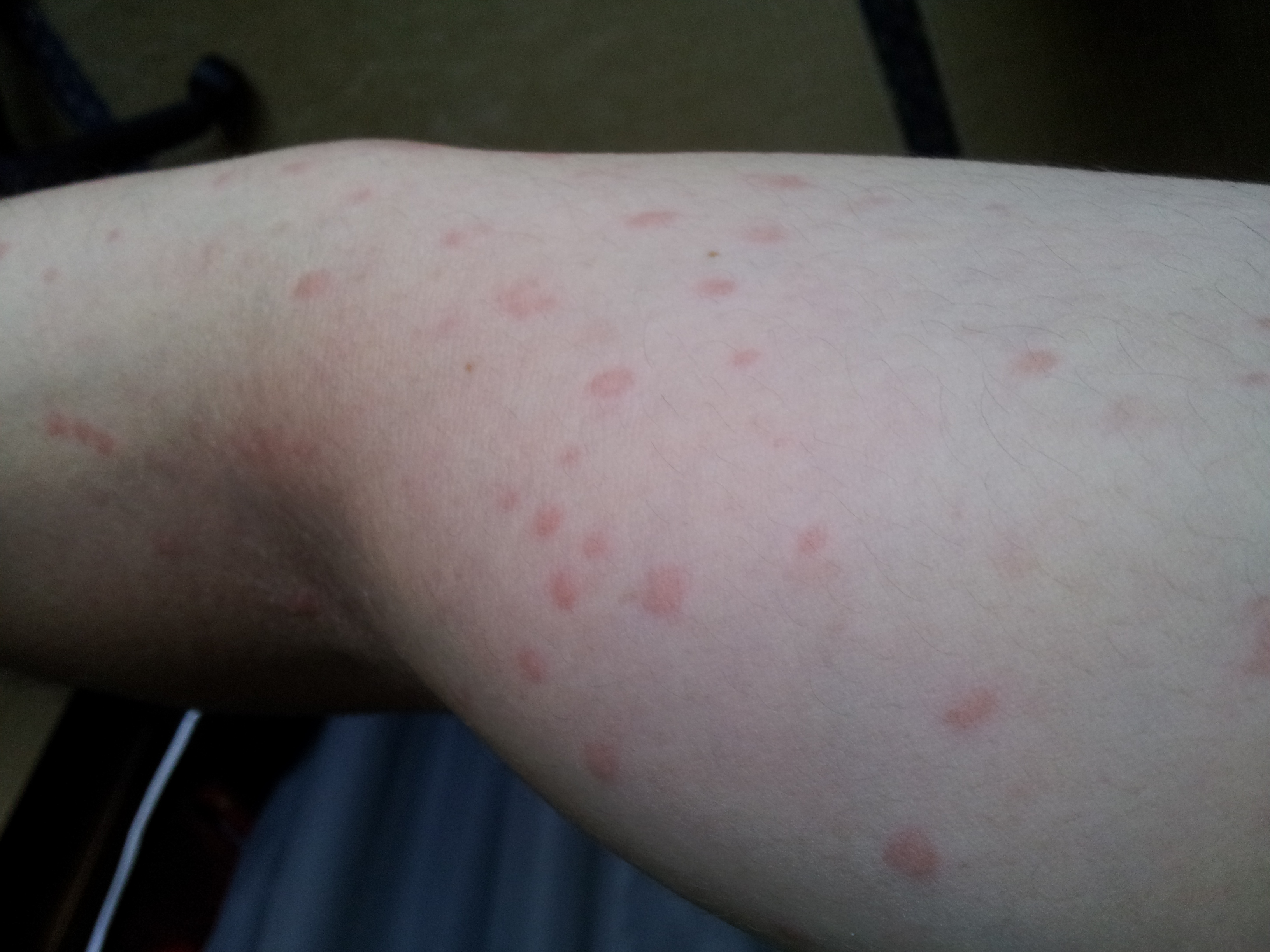 二の腕に大量に発生した赤くて痒い蕁麻疹