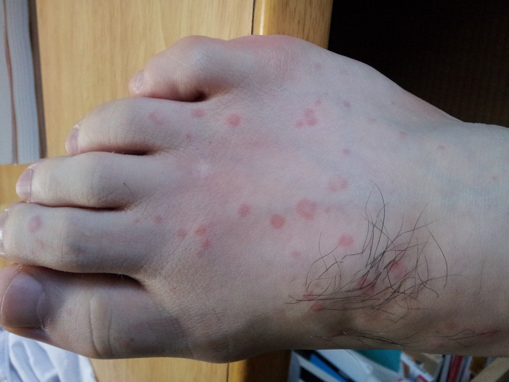 足の甲に出てきたコリン性蕁麻疹