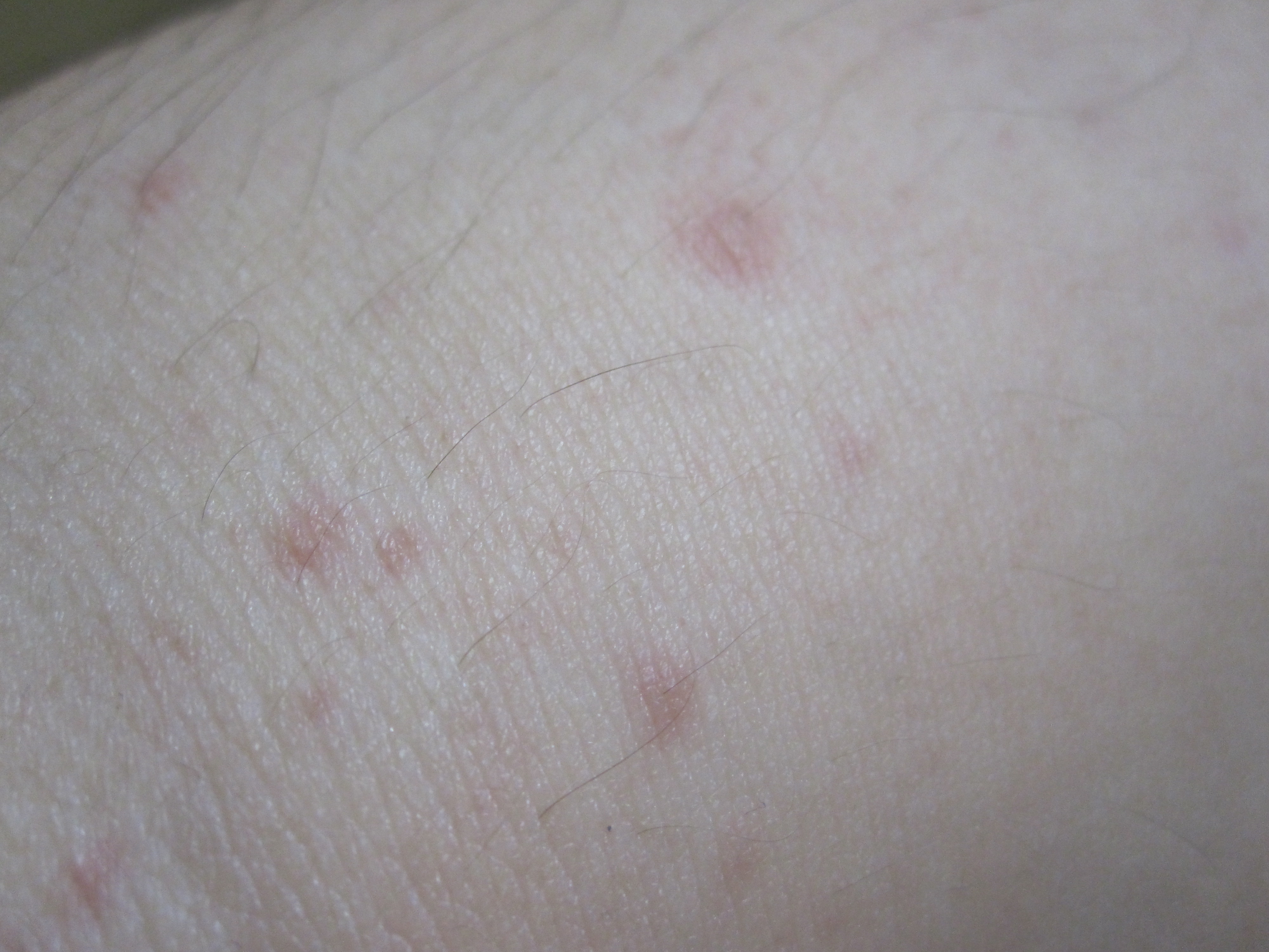 赤い斑点状の蕁麻疹
