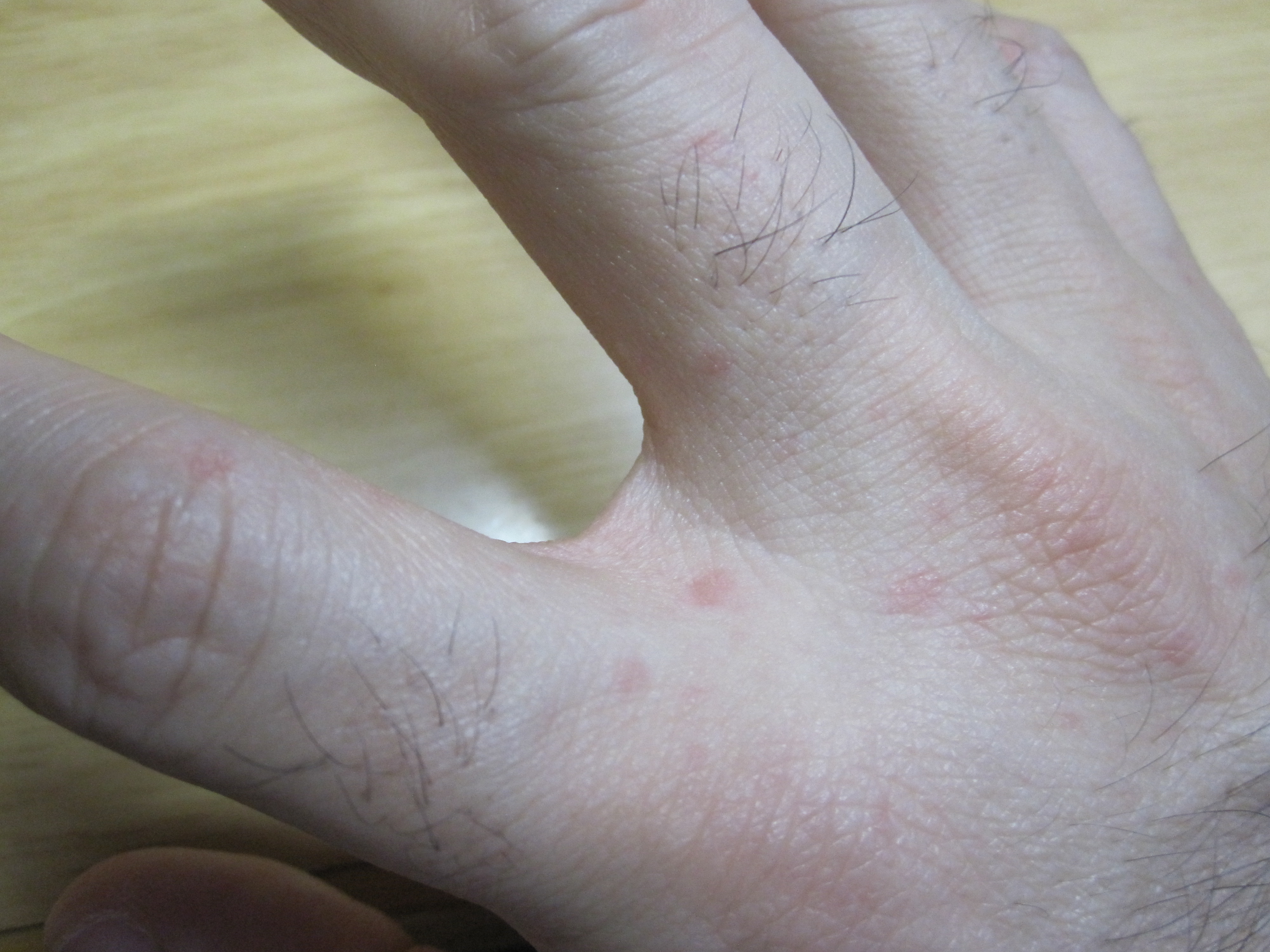 手の指と指の境目に出現した赤い発疹（じんましん）