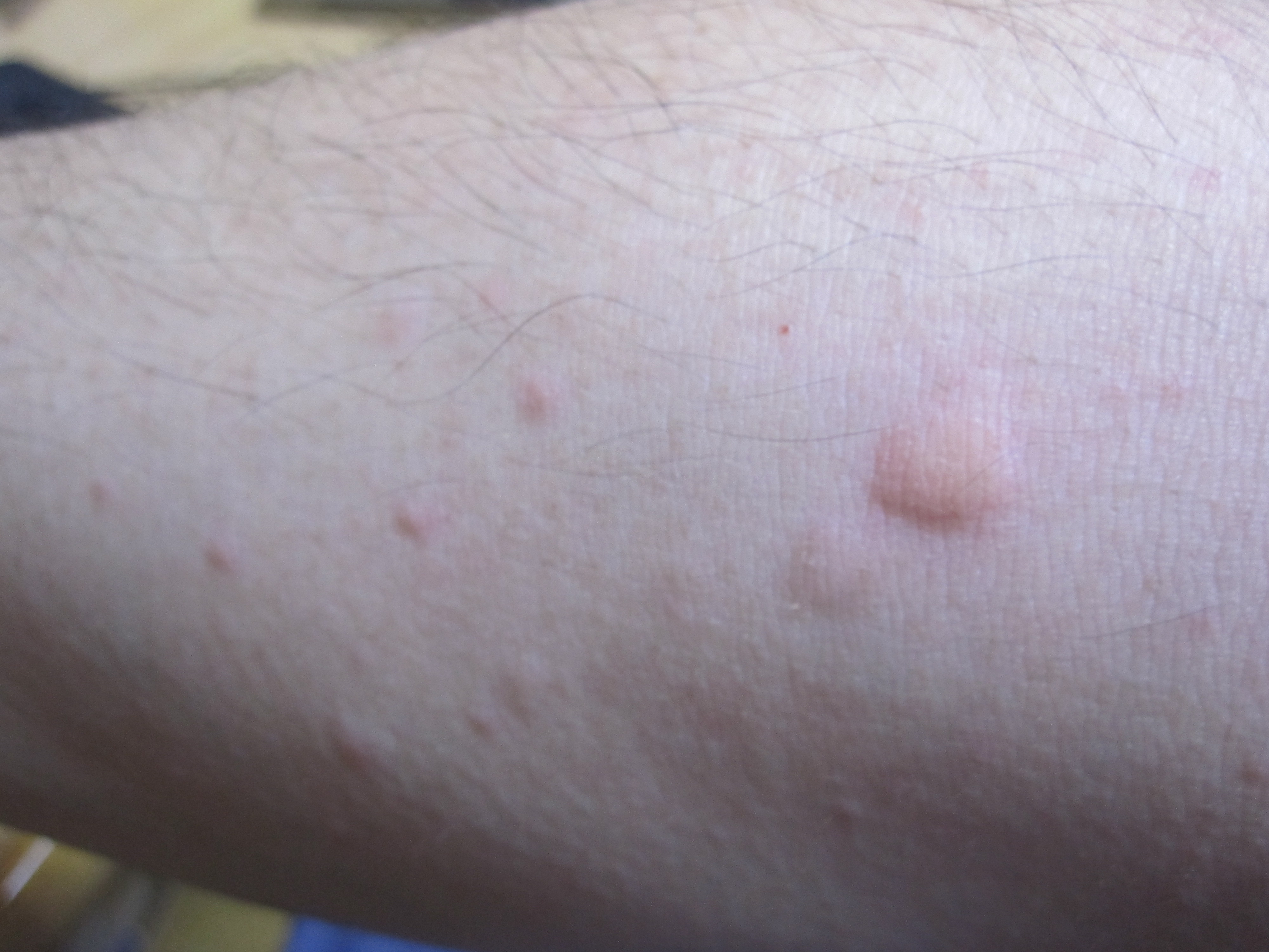コリン性蕁麻疹と蚊に刺された後の膨疹