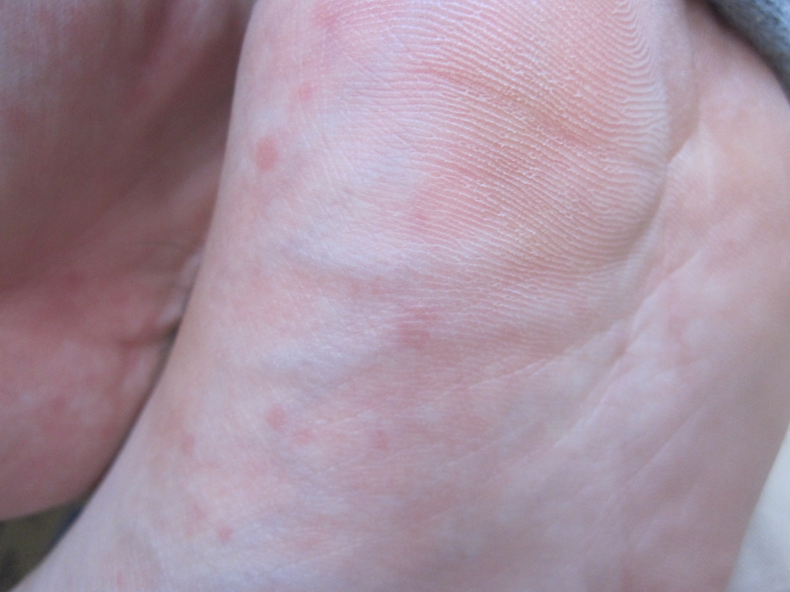 足の裏と甲に発症した蕁麻疹