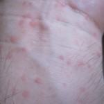 コリン性蕁麻疹は夕方から夜にかけて激しい痒みを伴って現れる！？