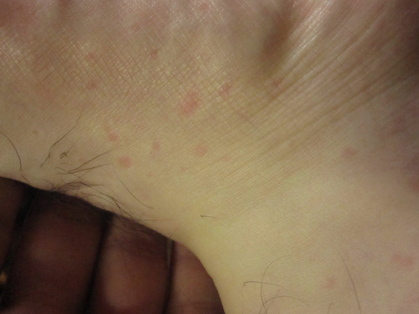 足の甲に出てきた蕁麻疹