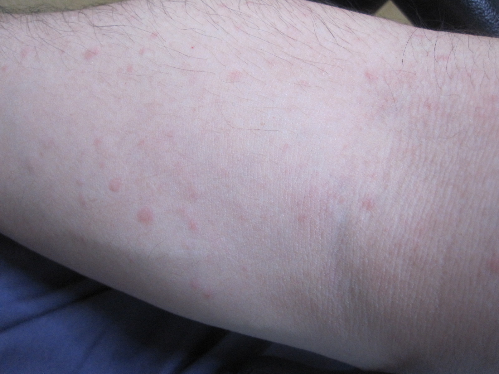 腕に出来た赤い蕁麻疹