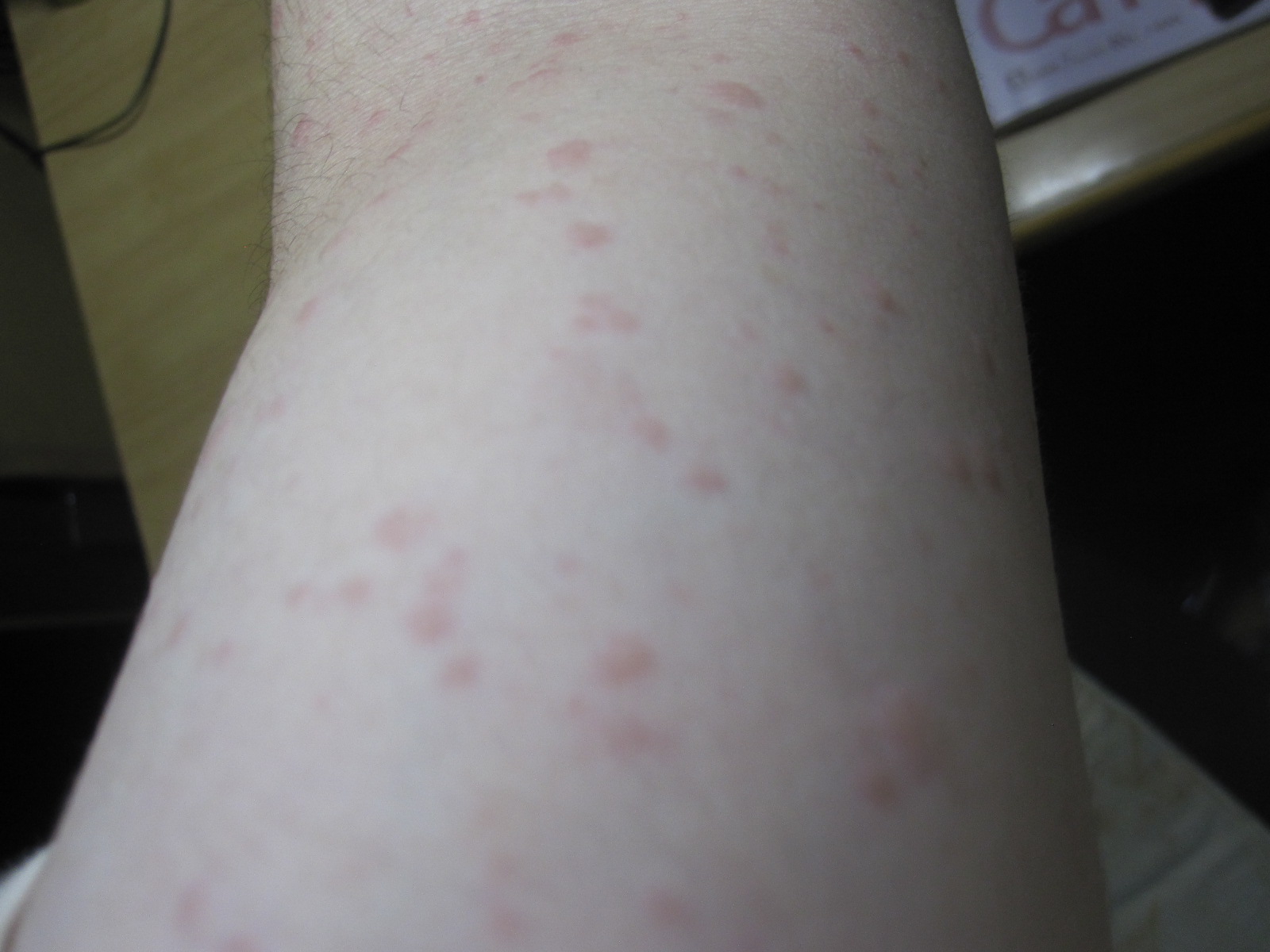 二の腕にたくさん出た蕁麻疹