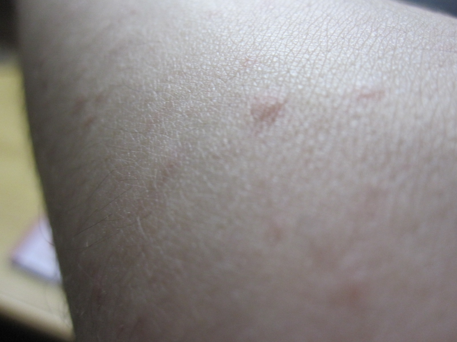 蚊の刺し痕と間違えそうな蕁麻疹
