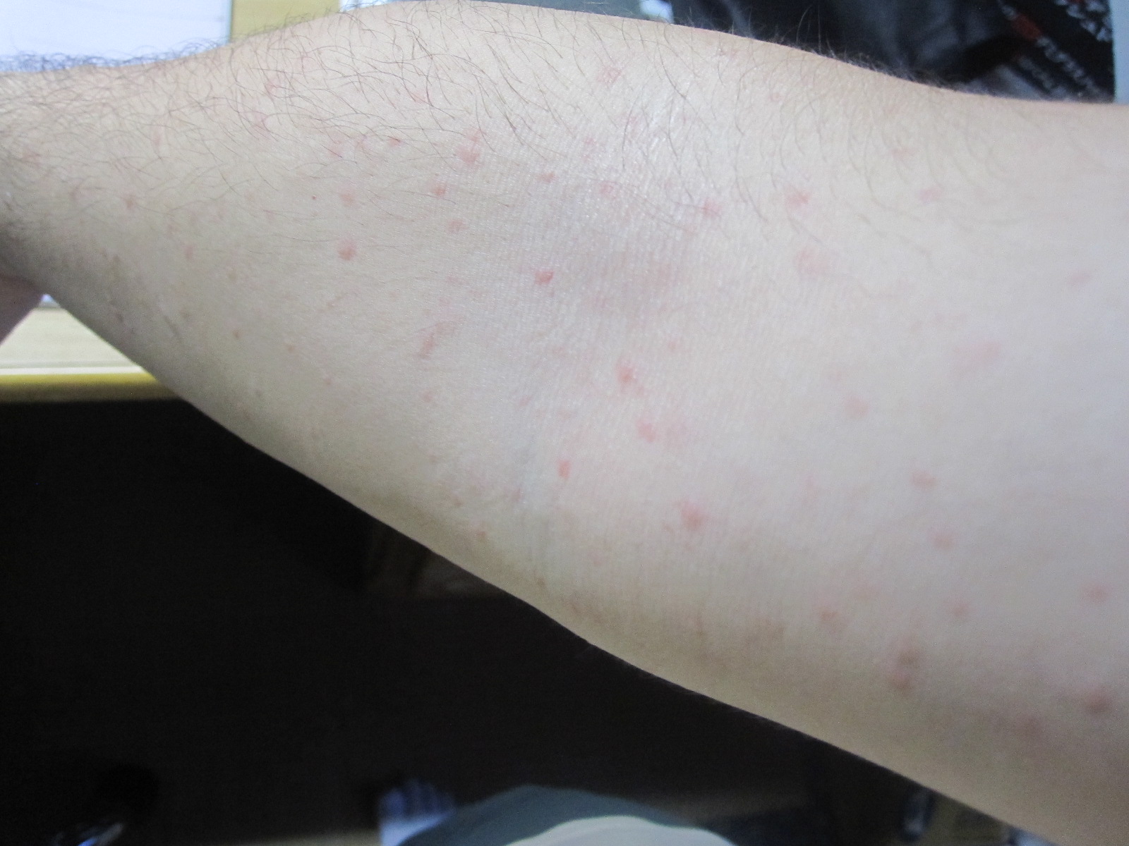 二の腕の広範囲に出た蕁麻疹
