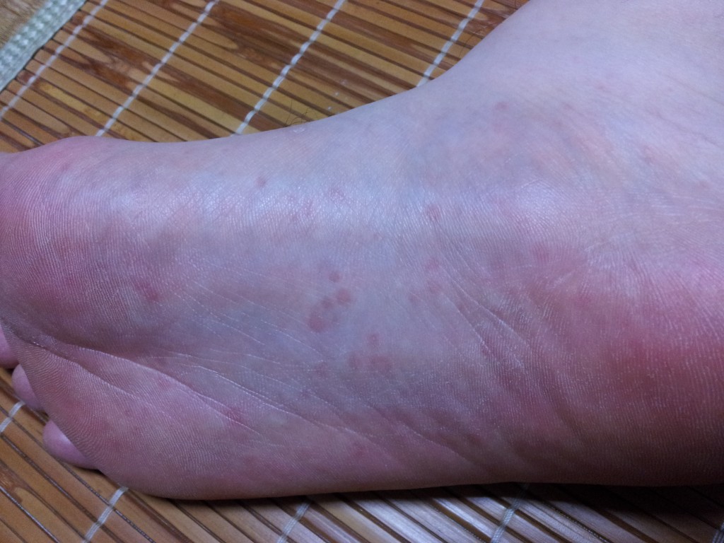 足の裏に出現した超絶に痒いコリン性蕁麻疹