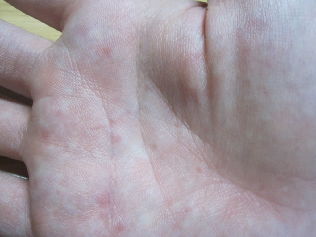 手の平に出てきた痒いコリン性蕁麻疹