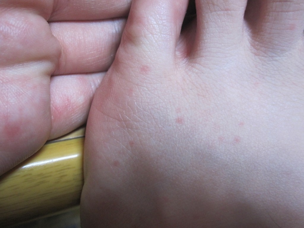 足の甲・指に出現したコリン性蕁麻疹