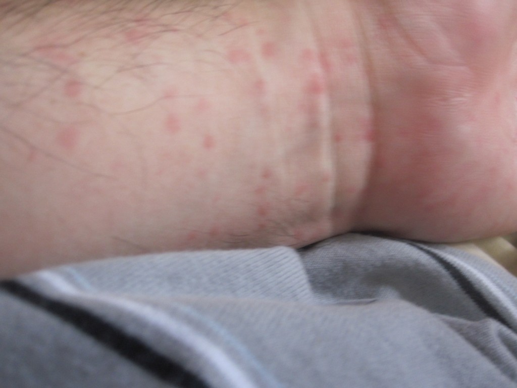 手首全体に広がった赤い発疹の蕁麻疹