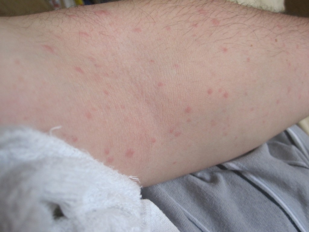 左腕に出てきた赤い発疹のコリン性蕁麻疹