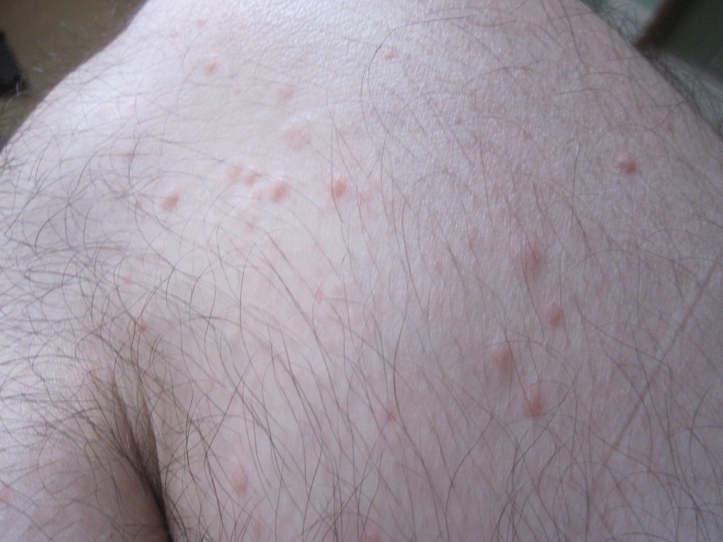 足の膝、太もも周辺に出てきた赤くて痒い蕁麻疹