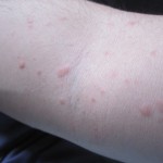 コリン性蕁麻疹の画像・写真