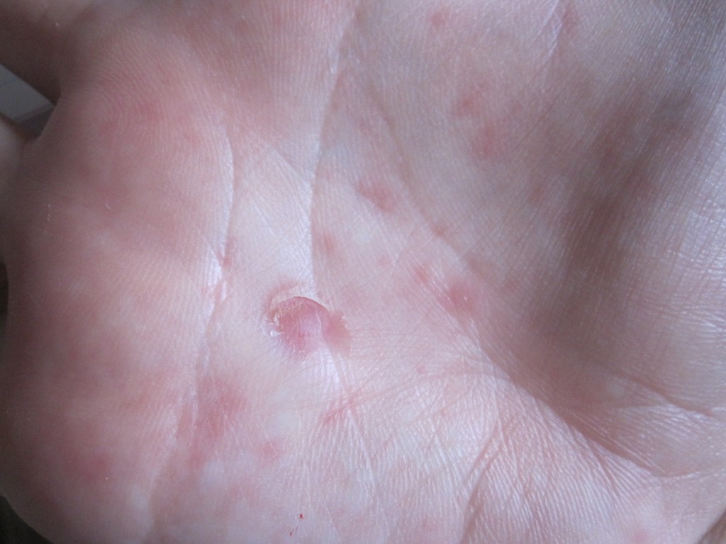手の平に現れた赤い斑点の蕁麻疹