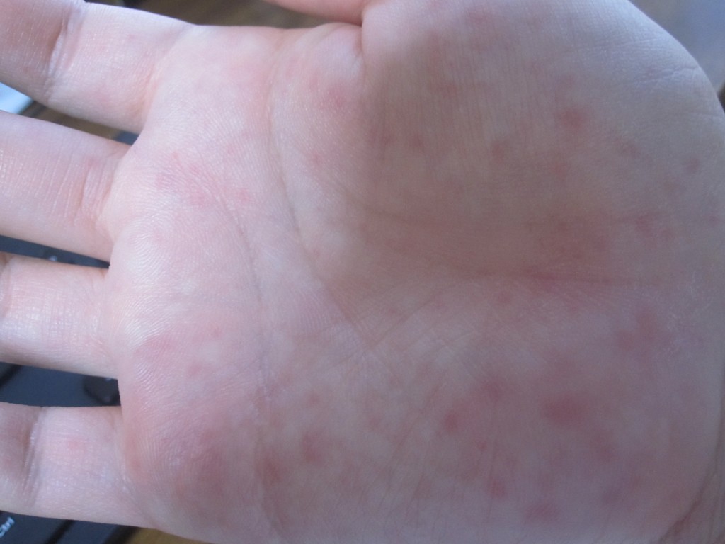 手の平の痒いコリン性蕁麻疹