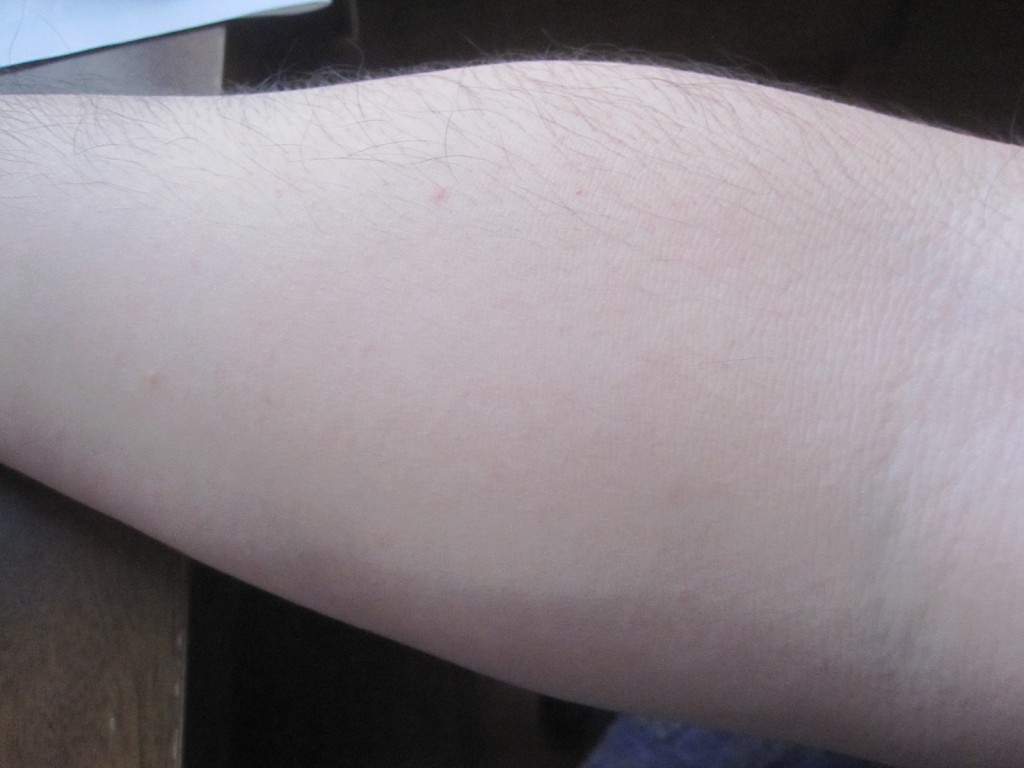 蕁麻疹の発疹・膨疹がない綺麗な腕