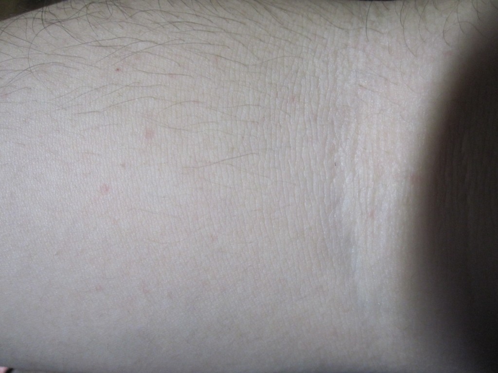 蕁麻疹の症状が見当たらない腕の皮膚