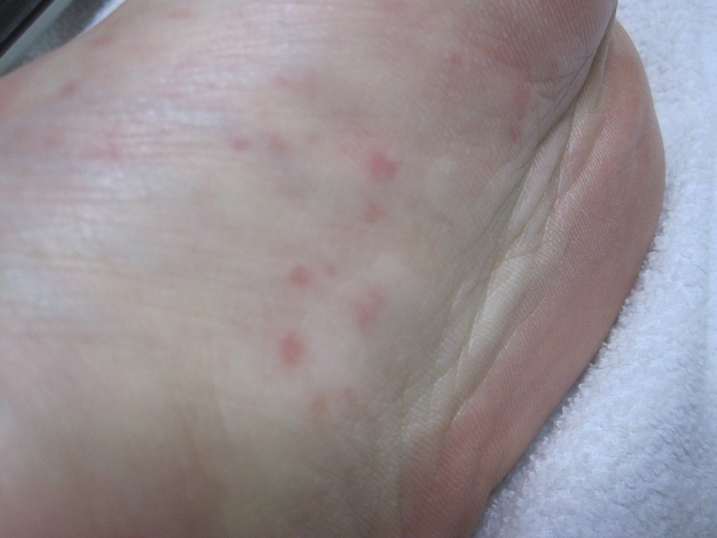 左足の裏に出たコリン性蕁麻疹