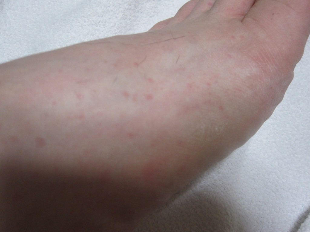 足の側面と甲に現れたコリン性蕁麻疹