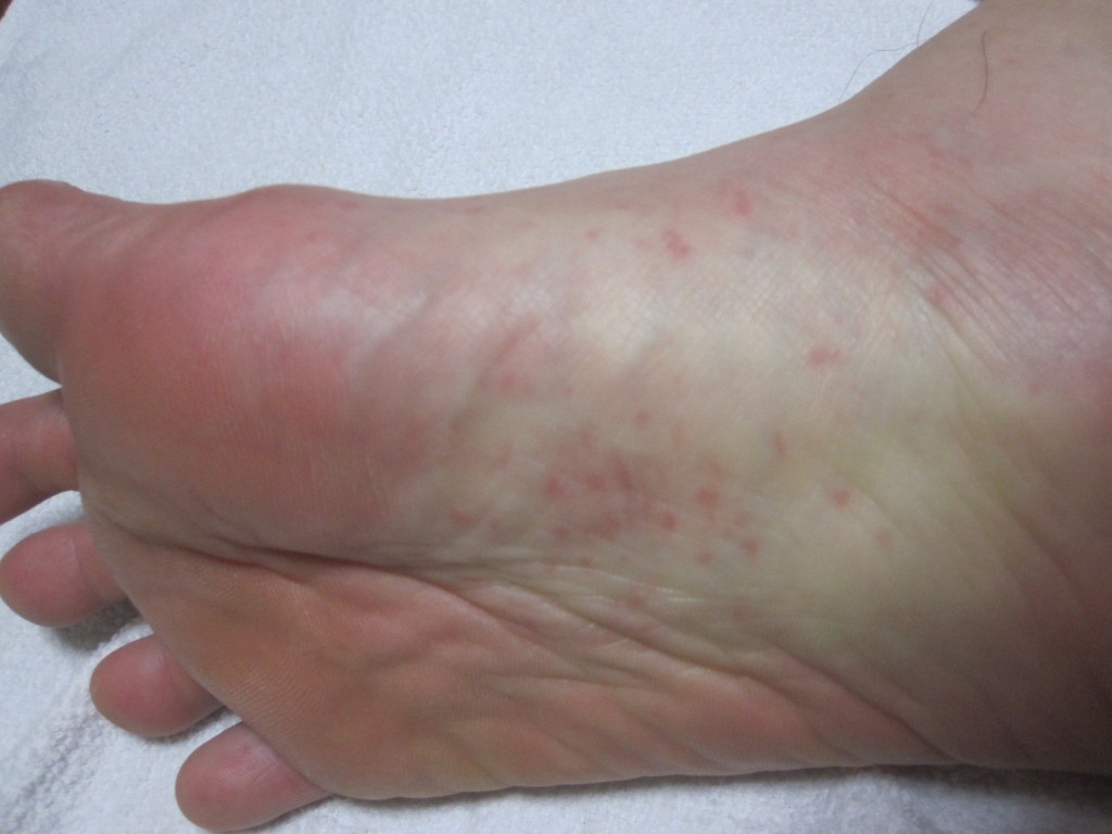右足の裏にも蕁麻疹の症状が見られる