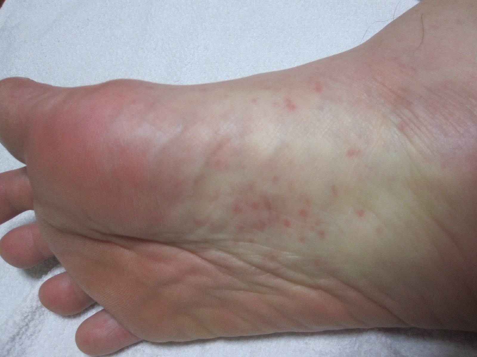コリン性蕁麻疹が足の裏に出現すると地獄の痒みに悶絶寸前 汗