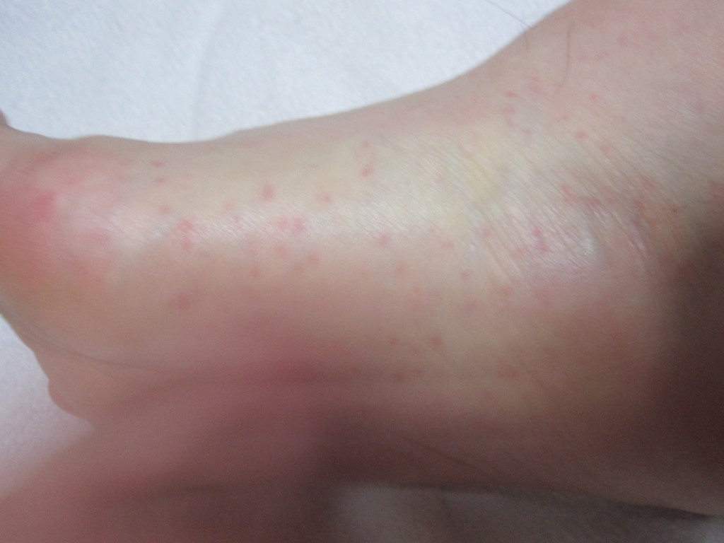 右足の側面に出てきた蕁麻疹のアップ写真