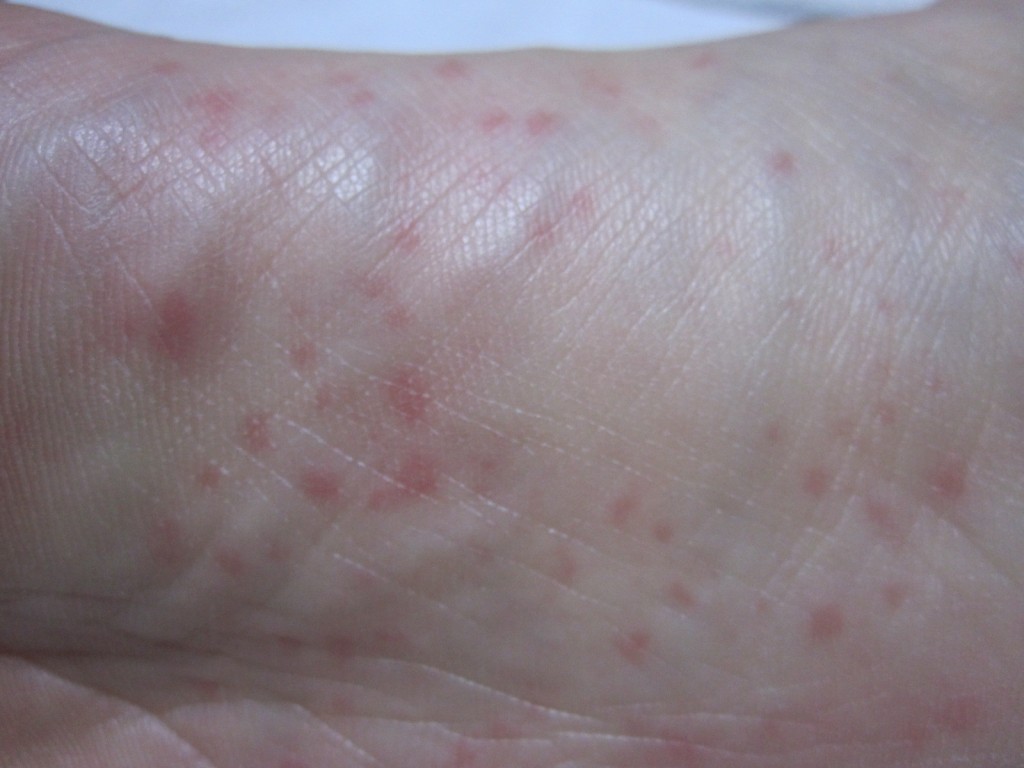 右足の赤い皮疹が痒そうな皮膚の様子