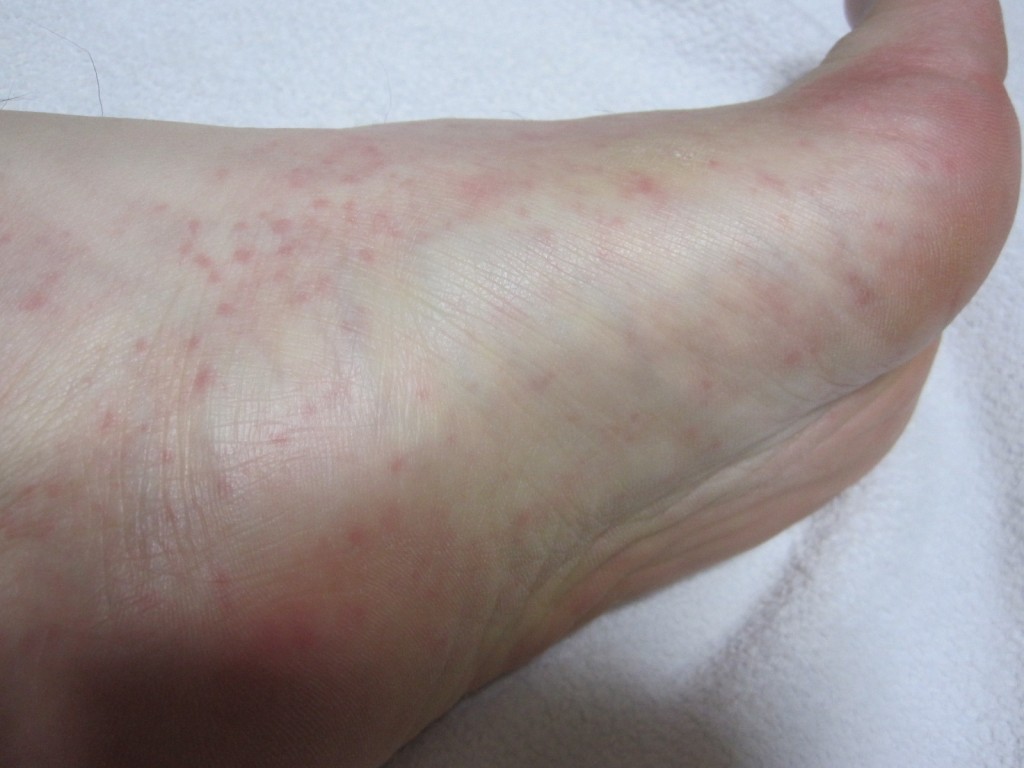 足の裏から側面と甲にかけて発症したコリン性蕁麻疹