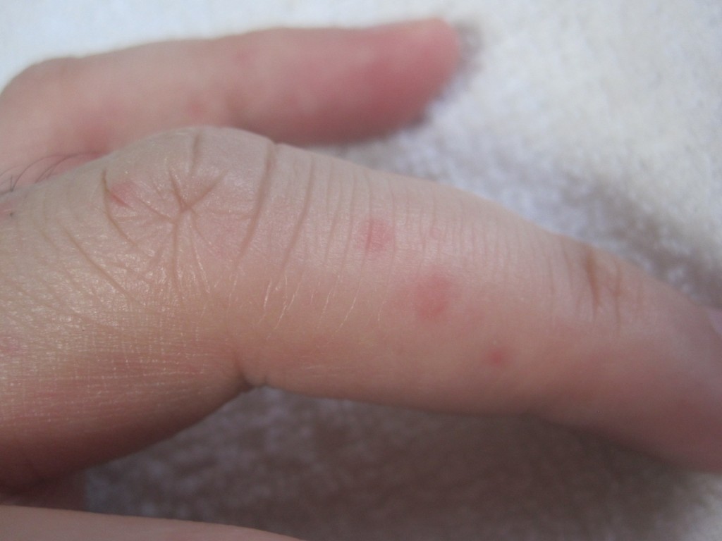 手の指に現れた痒いコリン性蕁麻疹