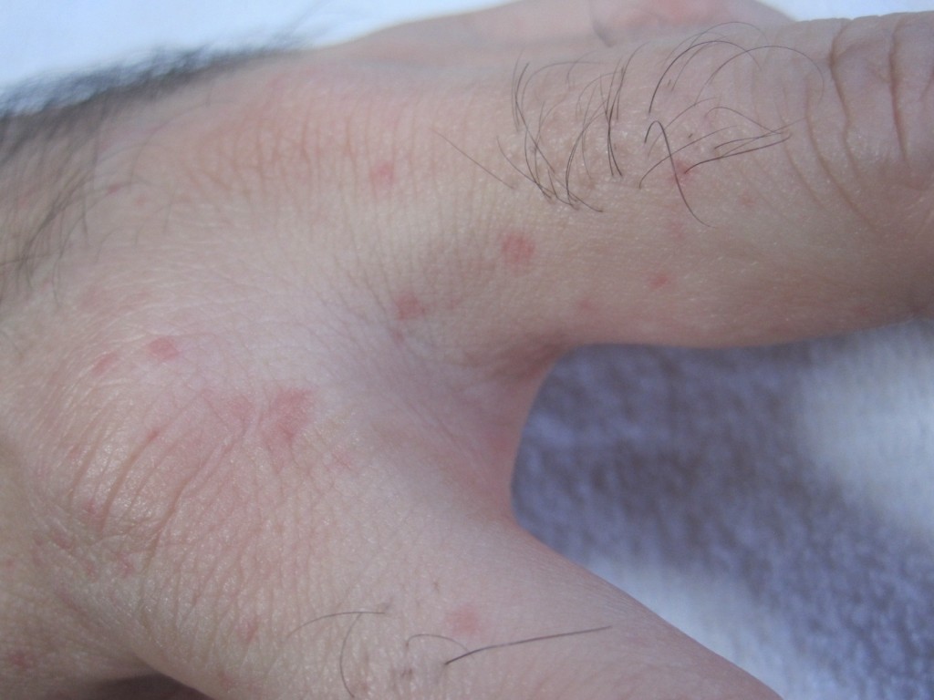 指と指の間の水かき部分にも蕁麻疹が発生する