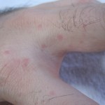 手の指にできるコリン性蕁麻疹が痒くてチクチク痛くて辛すぎる｡ﾟ(ﾟ´Д`ﾟ)ﾟ｡