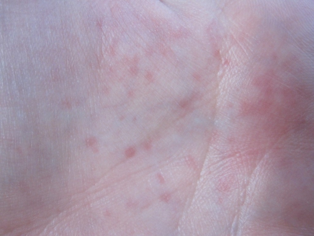 チクチク痛みと痒みをもったコリン性蕁麻疹