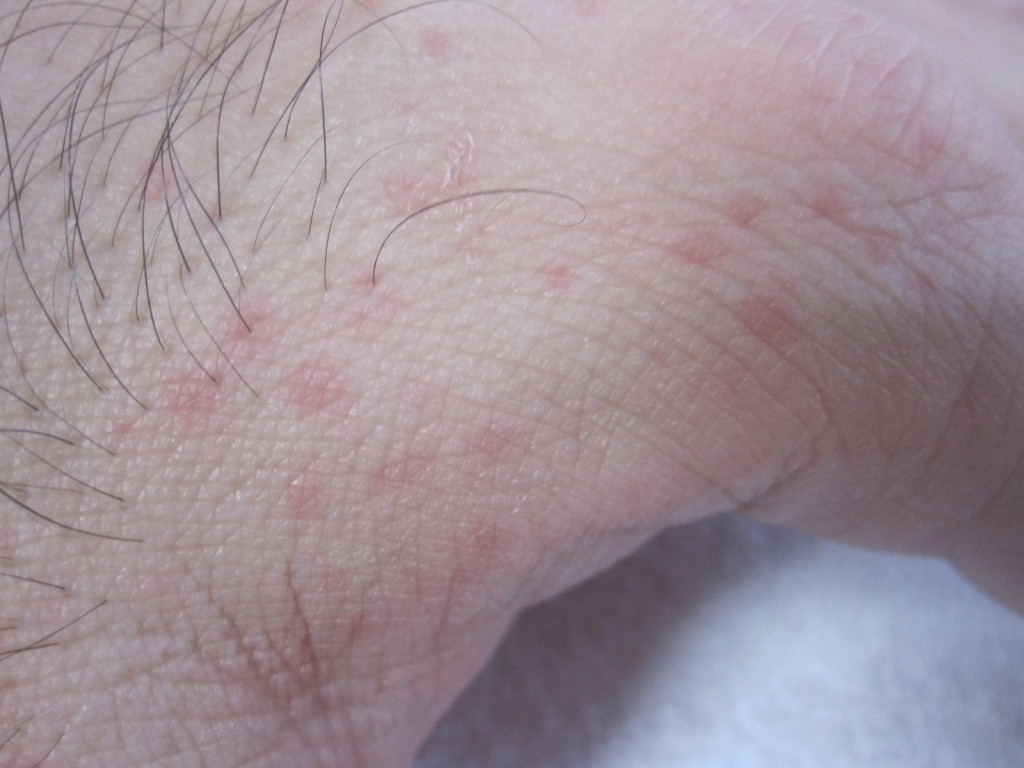 赤い発疹のコリン性蕁麻疹のアップ写真