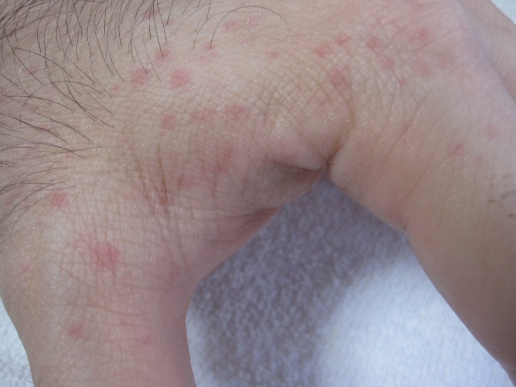 手の指の付け根部分に広がるコリン性蕁麻疹