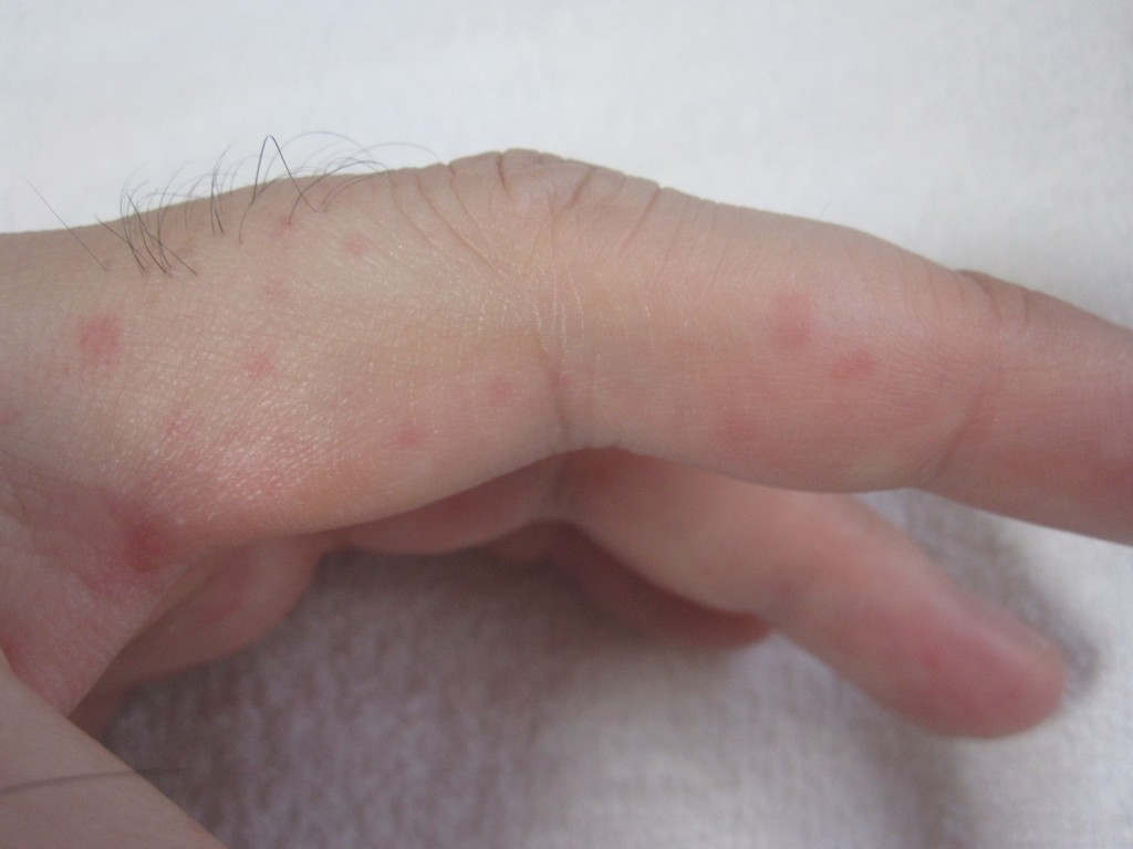 手の指に現れた痒いコリン性蕁麻疹