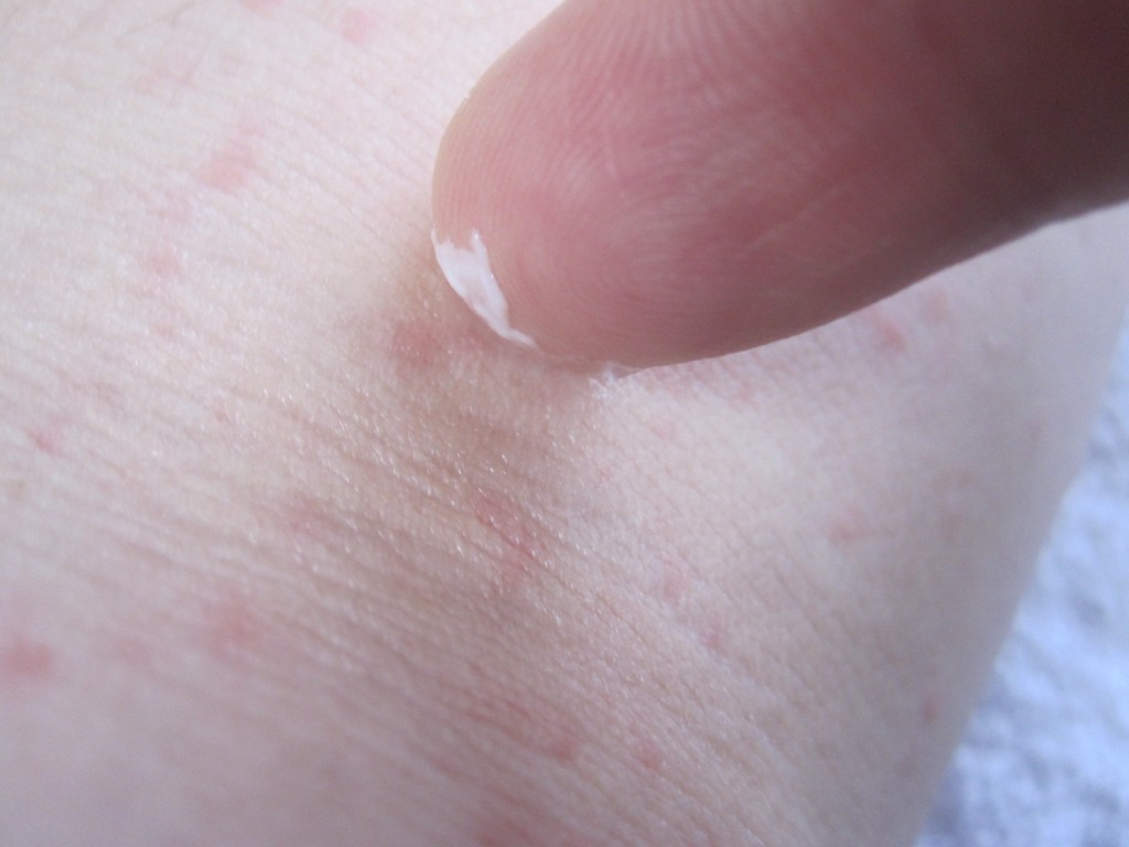 コリン性蕁麻疹が発症した患部に軟膏を塗り込む