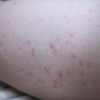 寒くなる冬にコリン性蕁麻疹が悪化する原因は暖房による外部からの熱・保温が影響していた？