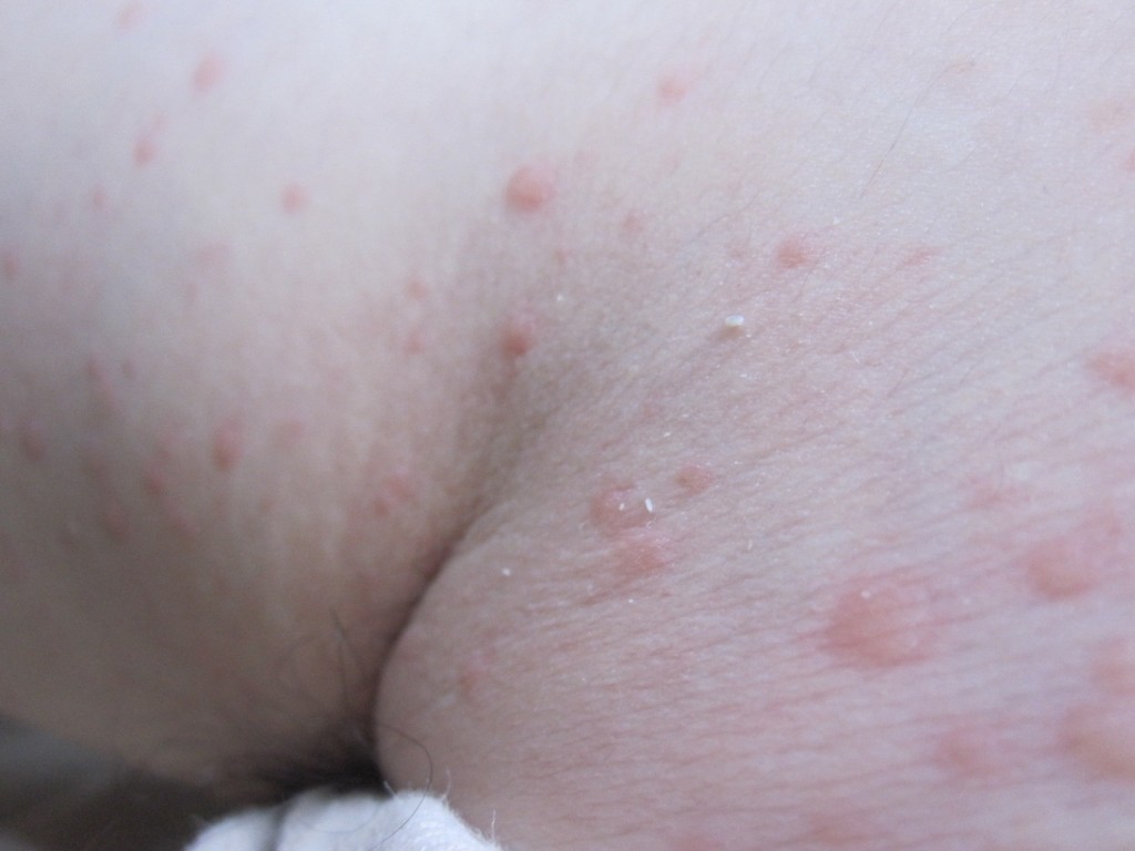 赤い膨疹と発疹が混ざった蕁麻疹が全身に広がる