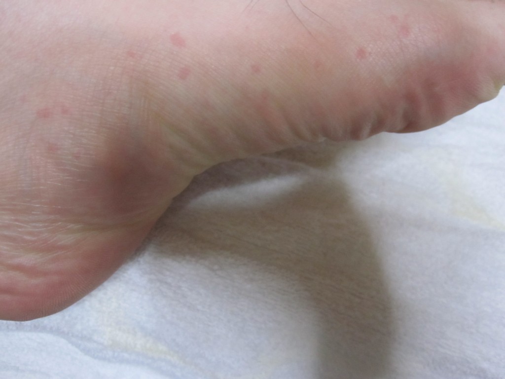 足の側面にまで出てきたコリン性蕁麻疹
