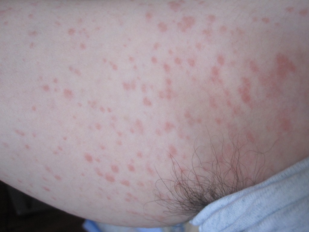 肩から脇、腕にかけておぞましいほど大量の膨疹が発生した皮膚