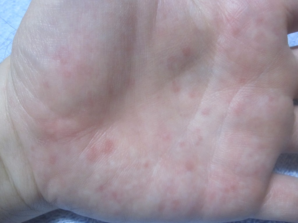 身体の中でも非常に痒い手の平のコリン性蕁麻疹