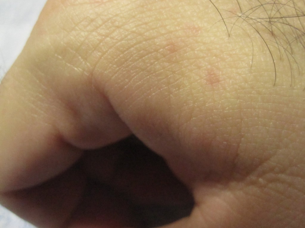 手の甲や側面にも蕁麻疹が出現した