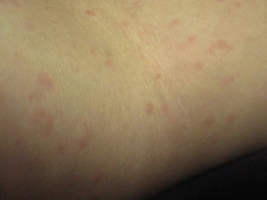 起床後に腕に出現していた赤い発疹・蕁麻疹