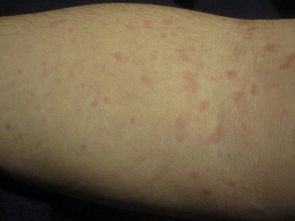 寒い冬には珍しく二の腕に大量に発生した蕁麻疹