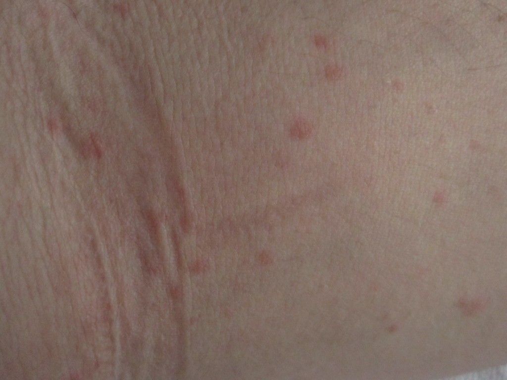 腕・肘の内側に出てきたコリン性蕁麻疹の症状