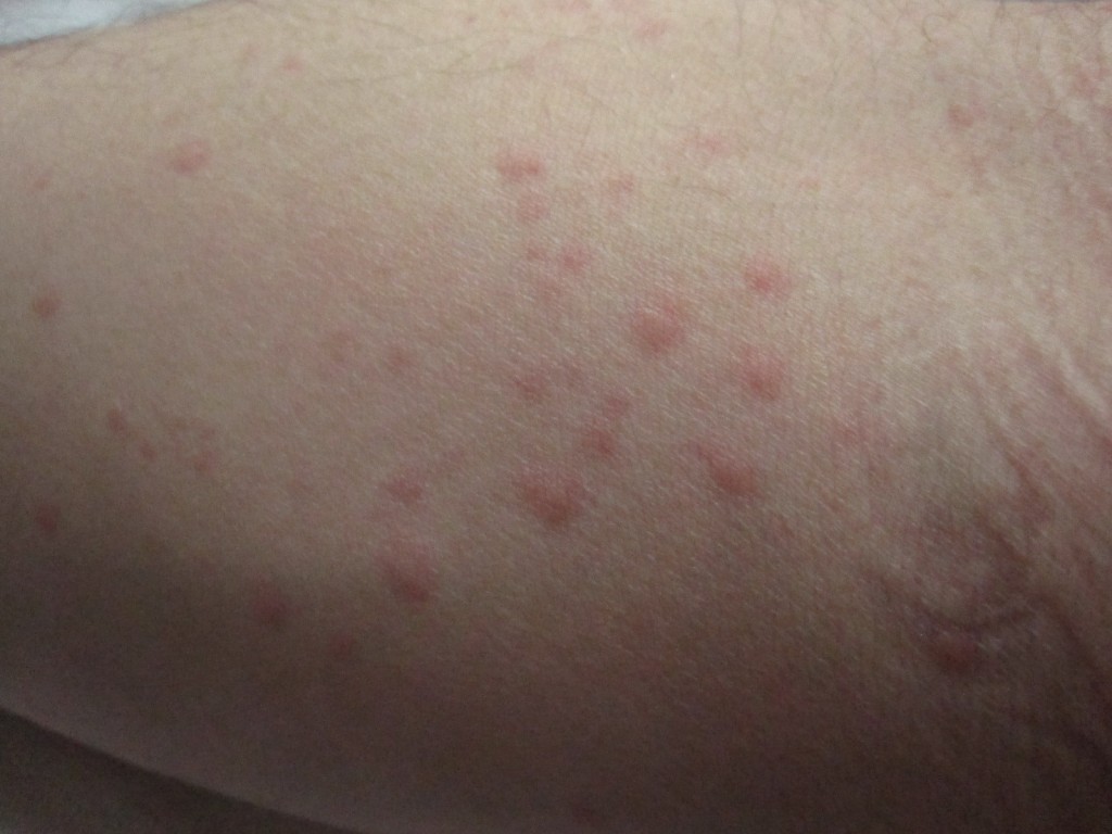シャツをまくってトイレの中で撮影した腕のコリン性蕁麻疹