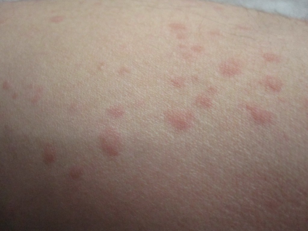 皮膚・肌の痒さと見た目の気持ち悪さが悩みのコリン性蕁麻疹